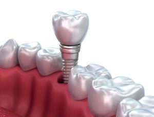 How Dental Implants Have Revolutionized Treatment for Tooth Loss
