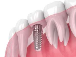 Your Most Common Dental Implant Questions Answered