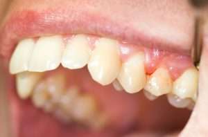 My gums bleed when I brush: Should I be concerned?