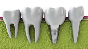 Congenitally Missing Teeth: What Are My Options?