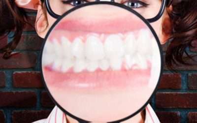 Reduce gummy smiles with veneers