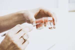 Everything to Know About Dental Implants