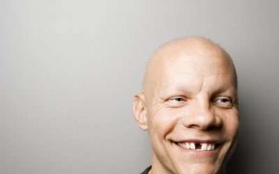 Dental Implants: Never Use Denture Adhesive Again